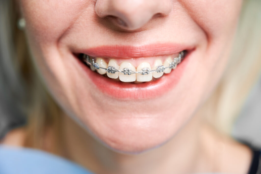 traditional metal braces