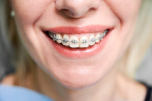 traditional metal braces