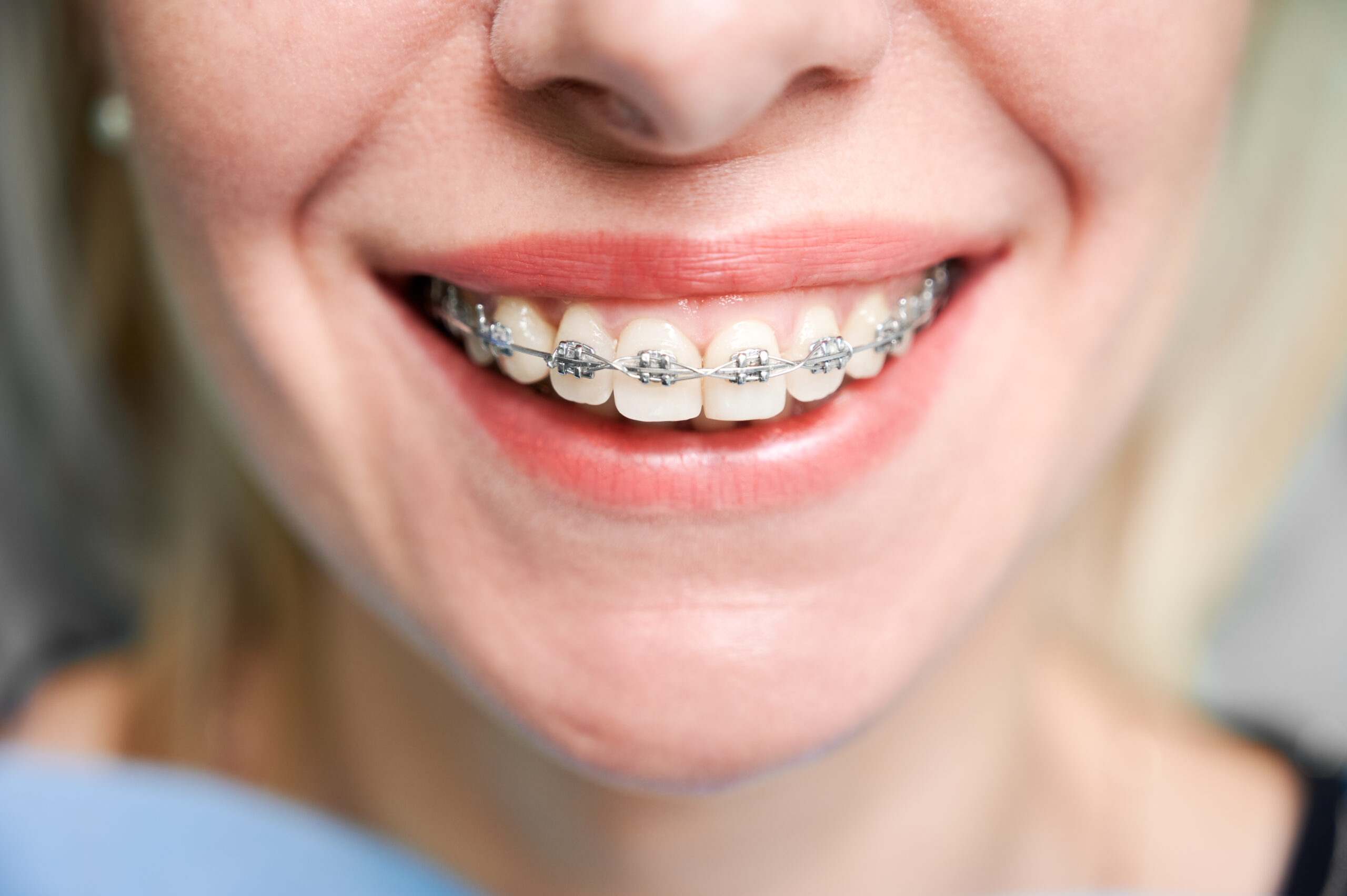 traditional metal braces