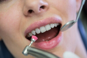 teeth cleaning in Santa Monica