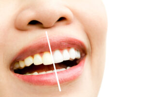 teeth whitening in Santa Monica
