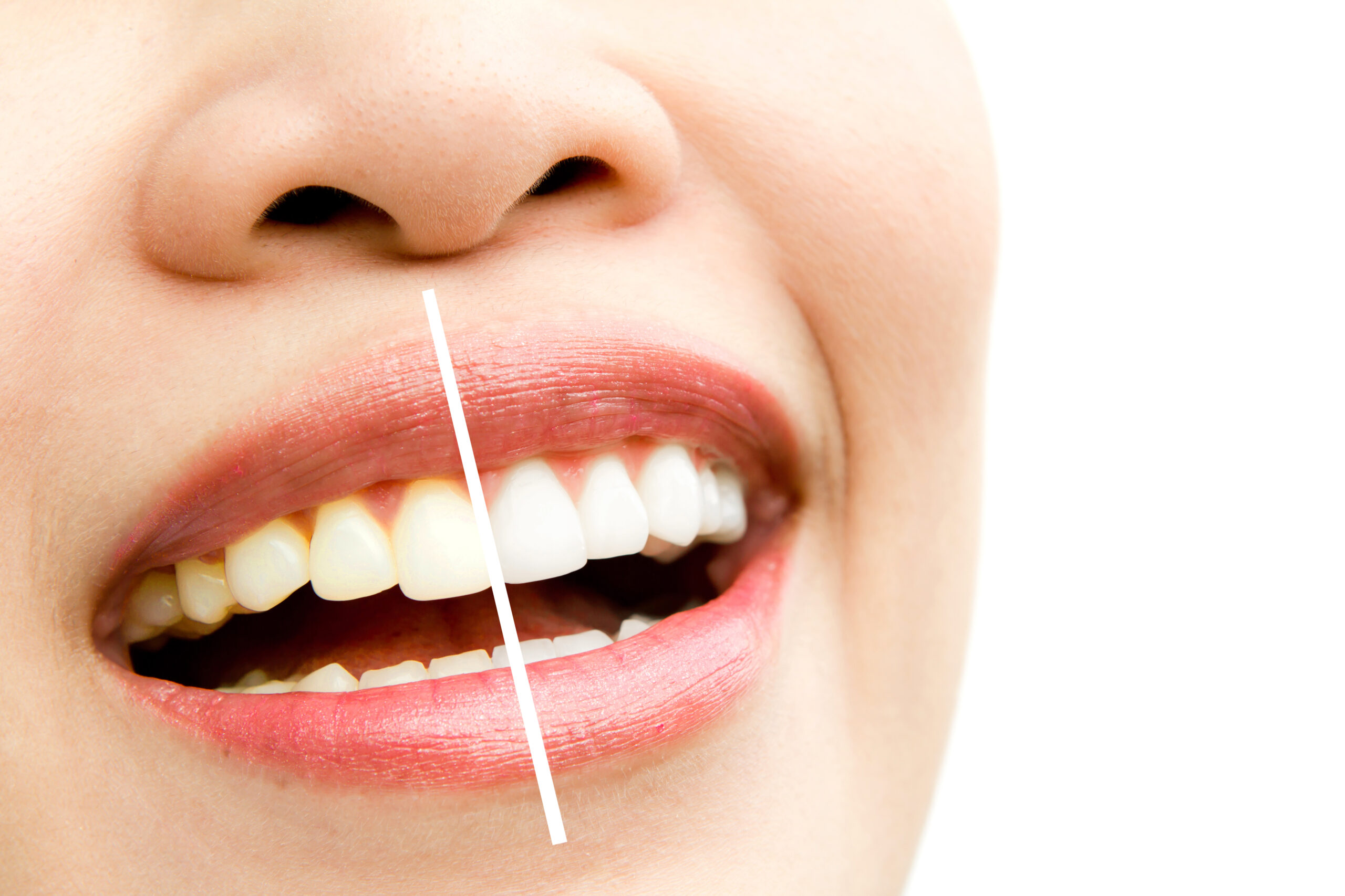 teeth whitening in Santa Monica