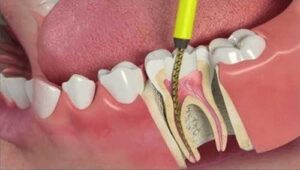 Root Canal Treatment