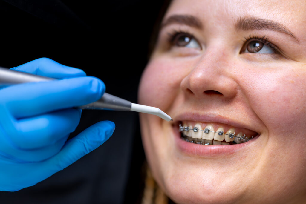 Teeth Braces