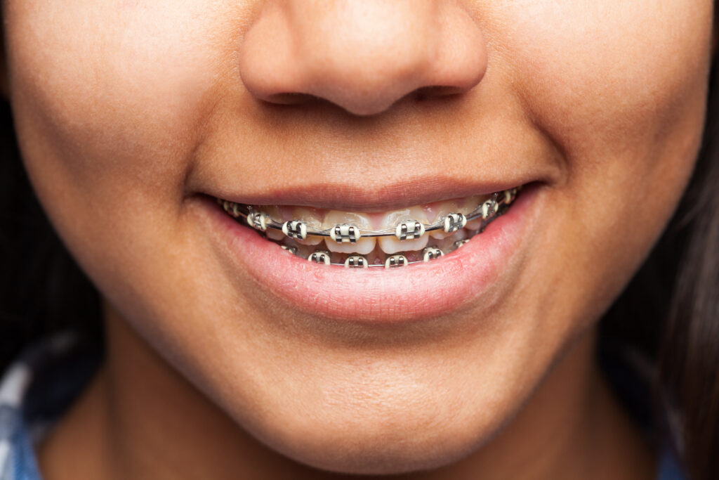 Teeth Braces