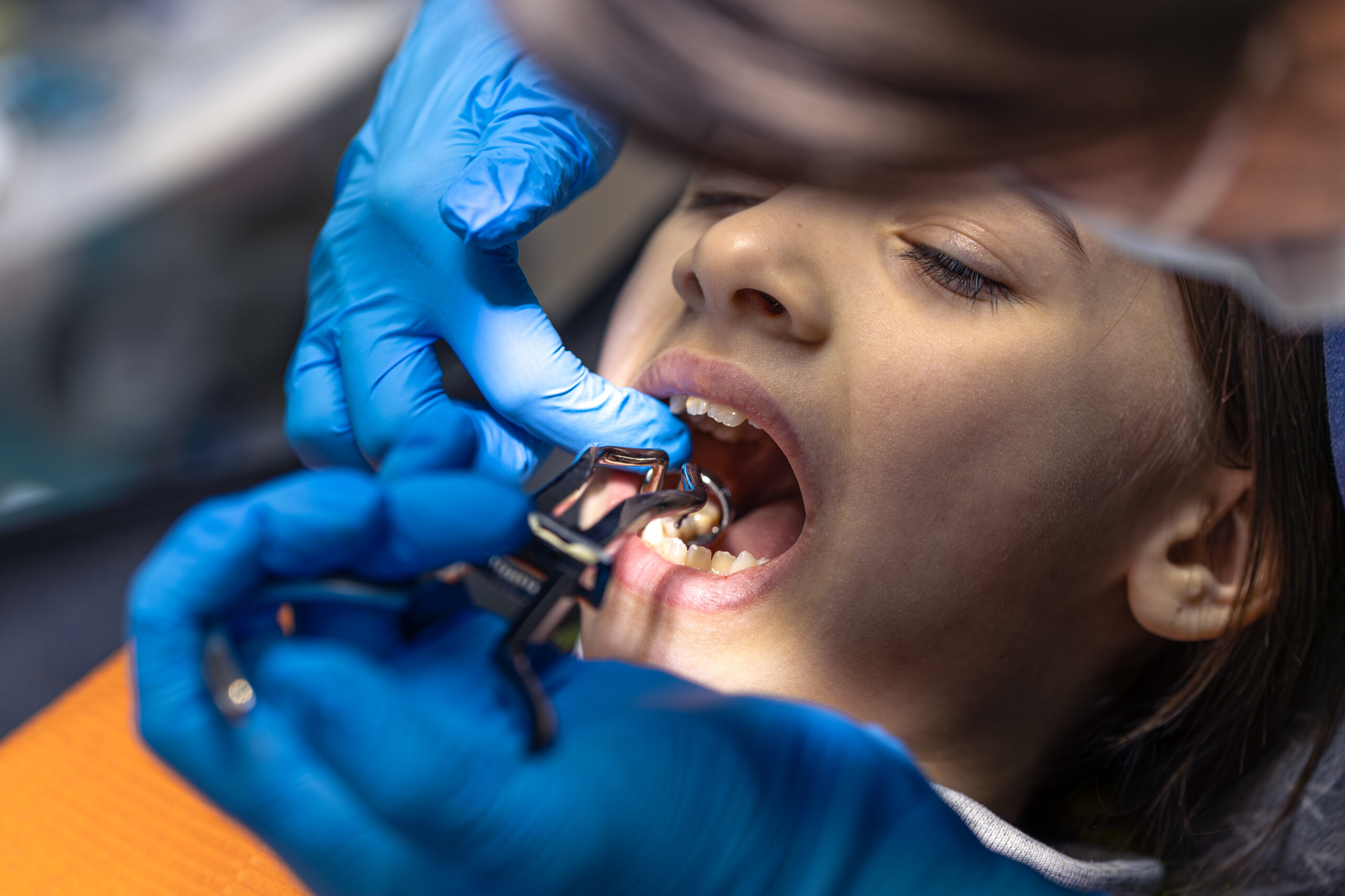 tooth extraction