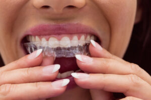 custom mouth guard