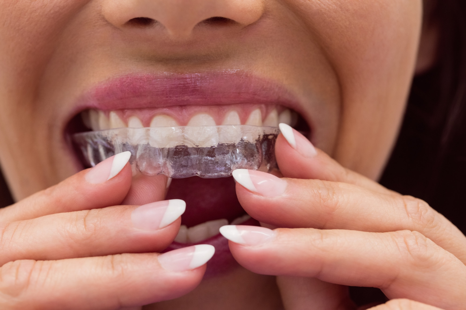 custom mouth guard